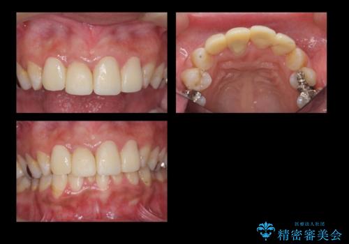 前歯の虫歯 つぎはぎの歯をセラミックにの治療中