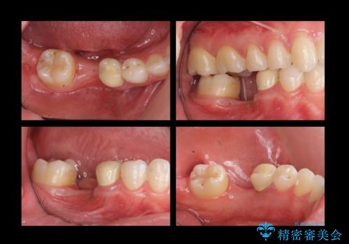 奥歯のインプラントの治療前