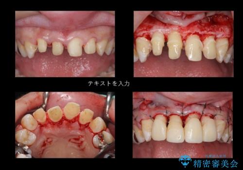 前歯の虫歯　つぎはぎの歯をセラミックにの治療中