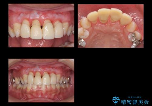 前歯の虫歯 つぎはぎの歯をセラミックにの治療中