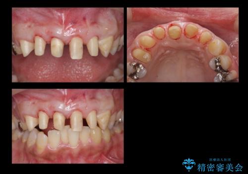 前歯の虫歯 つぎはぎの歯をセラミックにの治療中