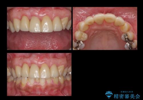前歯の虫歯 つぎはぎの歯をセラミックにの治療後