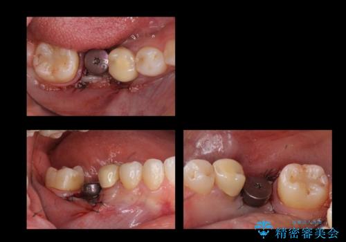 奥歯のインプラントの治療中