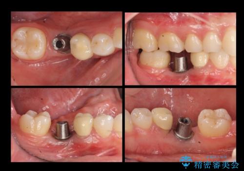 奥歯のインプラントの治療中