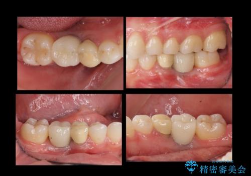 奥歯のインプラントの治療後