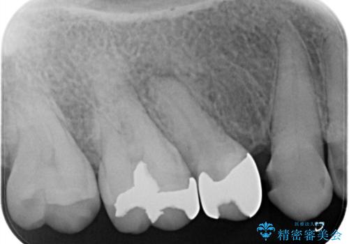 【メタルフリー】オールセラミッククラウンの治療前
