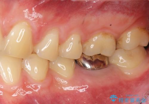 銀歯下の虫歯再発 インプラントによる機能回復の治療前