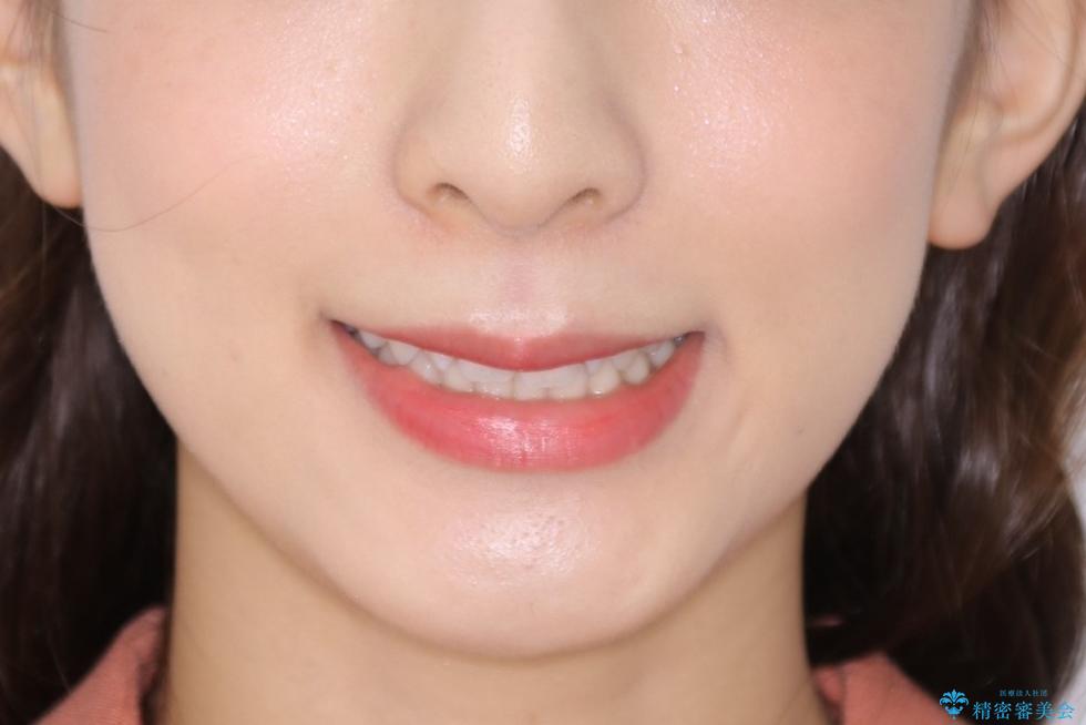 動きづらい前歯のねじれもマウスピース(インビザライン)で改善の治療前(顔貌)