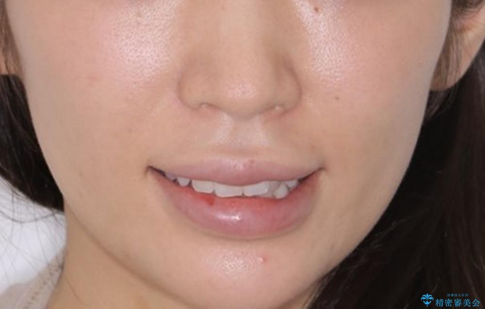 部分矯正とインビザラインを組み合わせて短期間での矯正治療の治療前(顔貌)