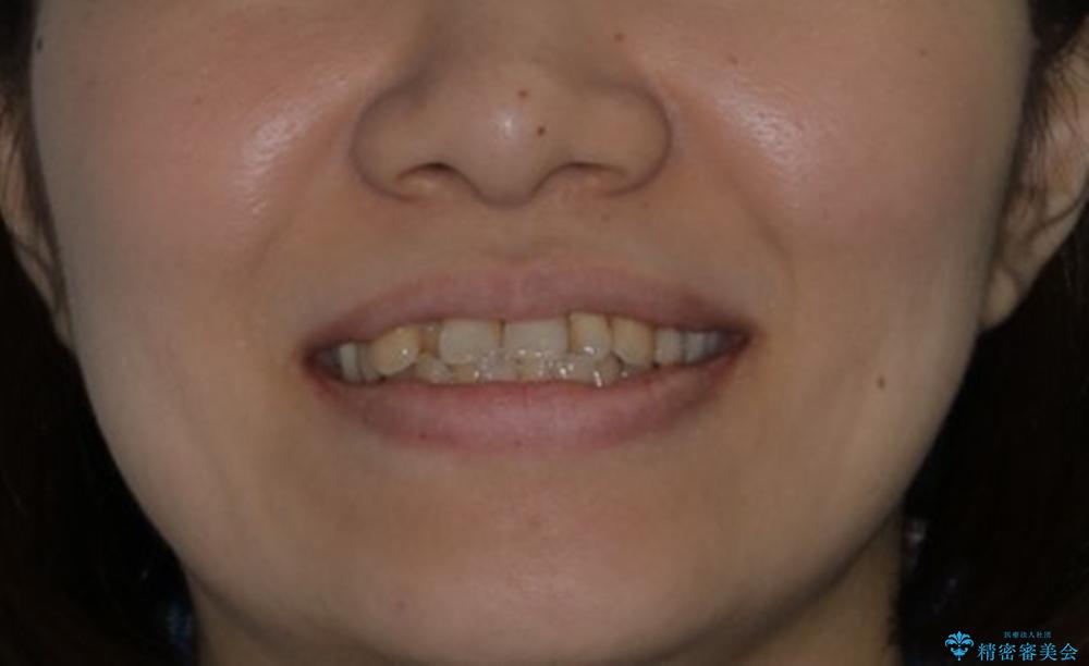 インビザラインで前歯の中心をお顔の中心に合わせるの治療前（顔貌）