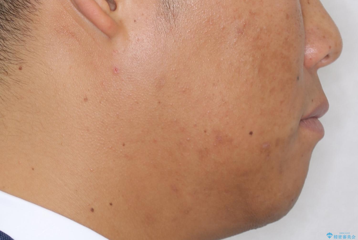 光加速矯正装置(オルソパルス)を用いた短期間での矯正治療の治療前(顔貌)