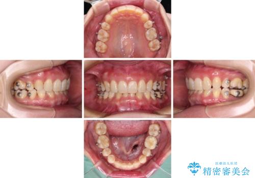 下顎2前歯の欠損　インビザラインによる抜歯矯正の治療後