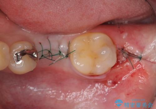 銀歯下の虫歯再発 インプラントによる機能回復の治療中