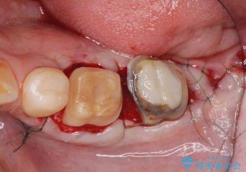 歯周外科で達成する、安定したクラウン周囲の歯肉環境の治療中
