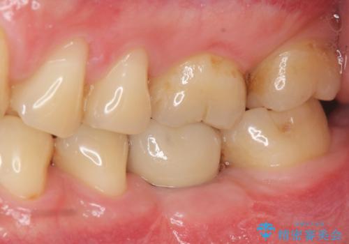 銀歯下の虫歯再発 インプラントによる機能回復の治療後