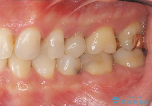 検診で判明した虫歯の再発の治療前