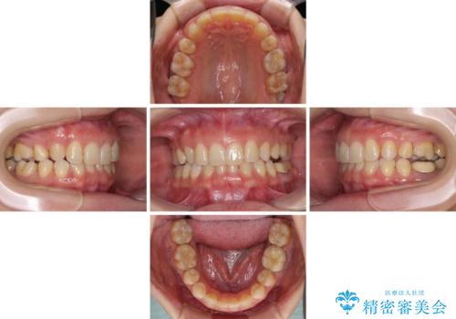 下顎2前歯の欠損 インビザラインによる抜歯矯正の治療前