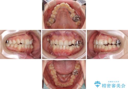 顕著な八重歯をインビザラインで治せるところまで改善の治療中