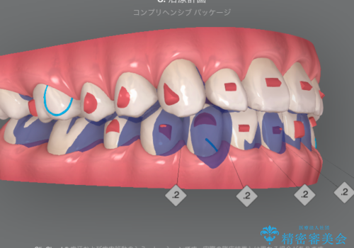 ガタつきの改善 マウスピース矯正治療