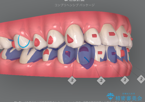 ガタつきの改善　マウスピース矯正治療