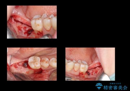奥歯の歯ぐきからウミが出る　抜歯してインプラントへの治療中