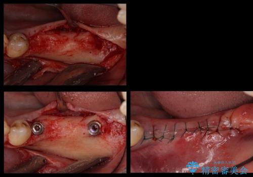 奥歯のインプラント 大人になって残っていた乳歯がダメになったの治療中