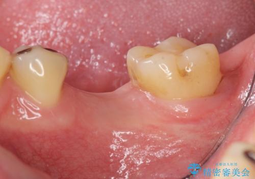 銀歯下の虫歯再発 インプラントによる機能回復の治療中