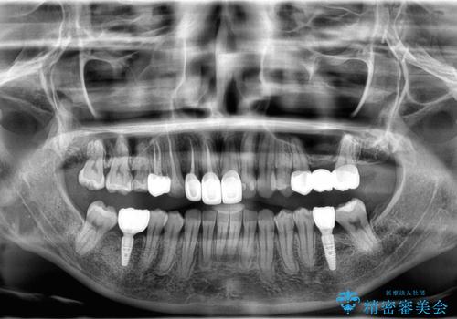 歯並びの改善とインプラントでのかみ合わせの回復　インプラント・セラミック・矯正全顎治療の治療後