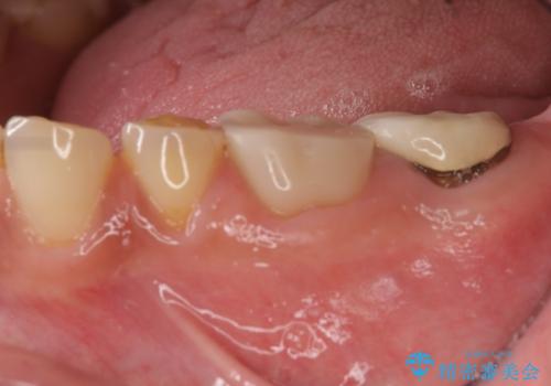 歯周外科で達成する、安定したクラウン周囲の歯肉環境の症例 治療前