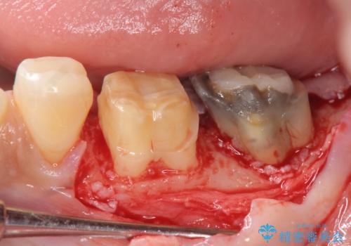 歯周外科で達成する、安定したクラウン周囲の歯肉環境の治療中