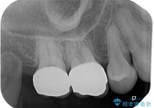 【オールセラミッククラウン】虫歯の治療の治療後