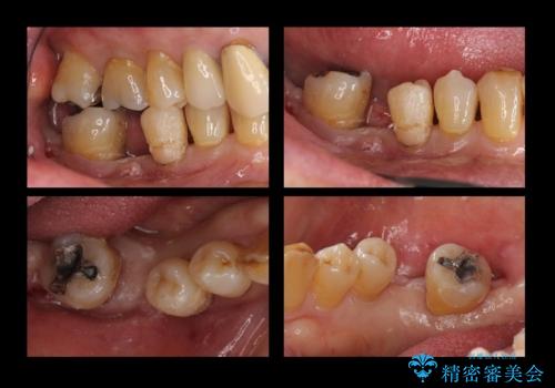 60代男性 奥歯のブリッジ 倒れこんでいる奥歯を部分矯正の治療中