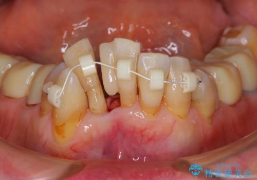 矯正治療とセラミック治療で口腔内環境を劇的に改善の治療前