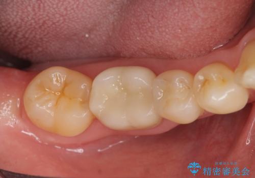 インレーとクラウン 銀歯をセラミックにやりかえの症例 治療後