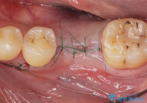 インプラントによる咬合機能回復の治療中