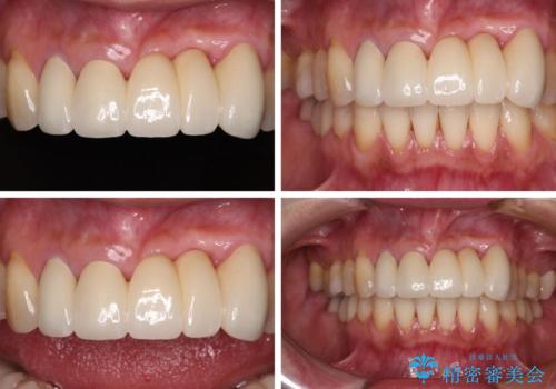 気になる所を一気に治療 総合歯科治療の治療後
