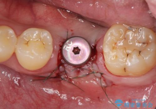 インプラントによる咬合機能回復の治療中