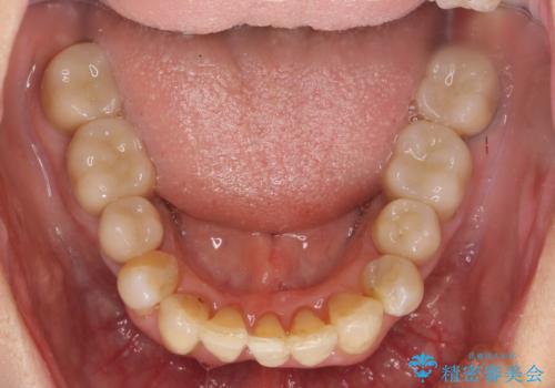 矯正治療とセラミック治療で口腔内環境を劇的に改善の治療後