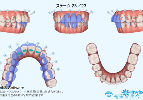 矯正治療とセラミック治療で口腔内環境を劇的に改善