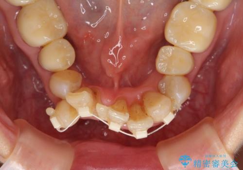 矯正治療とセラミック治療で口腔内環境を劇的に改善の治療中