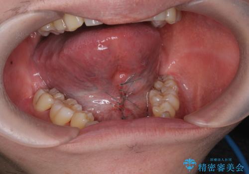 舌小帯の形成で達成する滑舌の改善の治療中