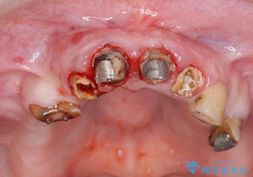 多発した虫歯による咬合崩壊    インプラントを用いた全顎治療の治療前