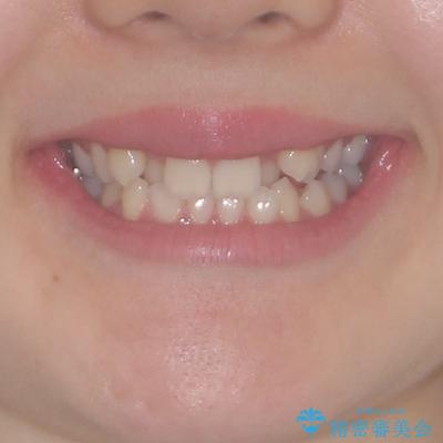目立つ八重歯を目立たない装置で　ハーフリンガルによる抜歯矯正の治療前（顔貌）
