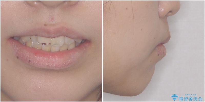 怪我をして不格好な前歯　矯正治療とインプラント補綴治療の治療前（顔貌）