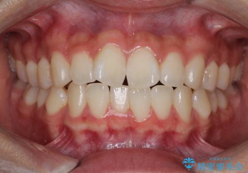 前歯のがたがたを綺麗にしたいの症例 治療前