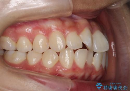 前歯のがたがたを綺麗にしたいの治療前