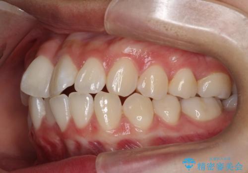 前歯のがたがたを綺麗にしたいの治療前