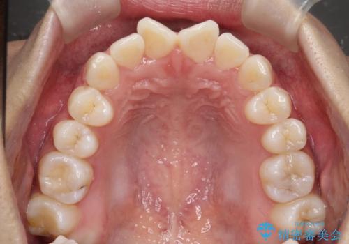 前歯のがたがたを綺麗にしたいの治療前