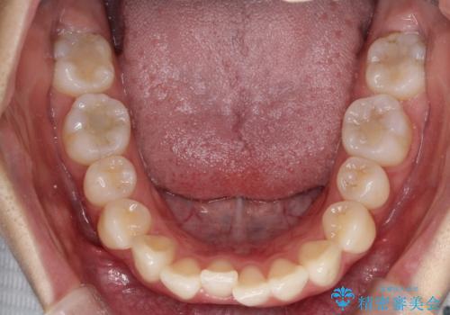 前歯のがたがたを綺麗にしたいの治療前