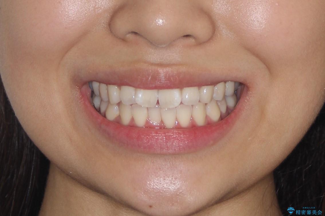 前歯のがたがたを綺麗にしたいの治療前(顔貌)